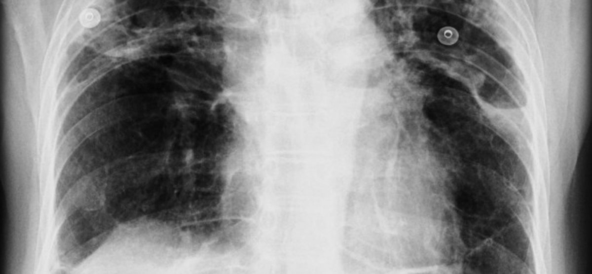 Bệnh bụi phổi (Silicosis) trên phim X-quang